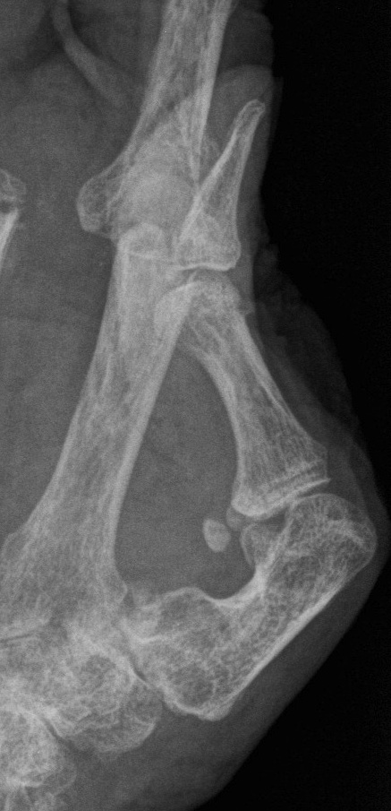 Rheumatoid Boutonniere Thumb